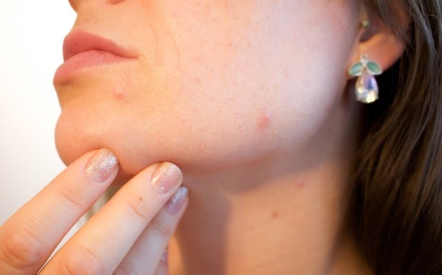 common skin issues consult dermatologist skin care problems acne psoriasis eczema