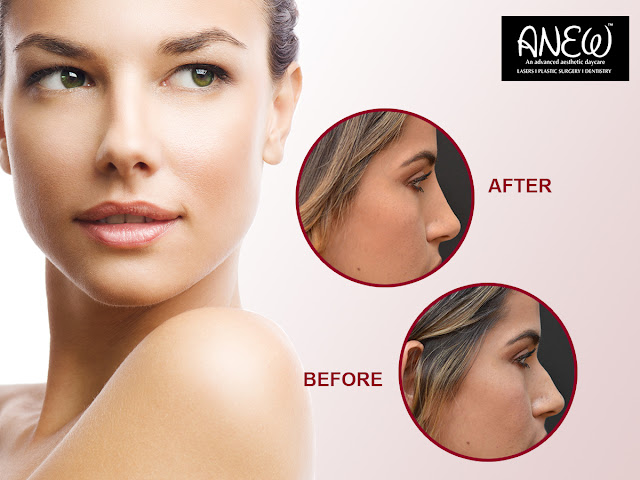 non surgical rhinoplasty in Bangalore