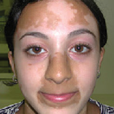 eye color and vitiligo