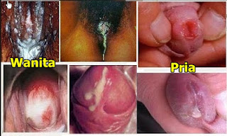 Jual Obat kencing Nanah Pada Pria Dan Wanita