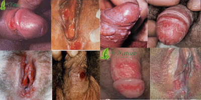 Obat Sifilis Dan Herpes