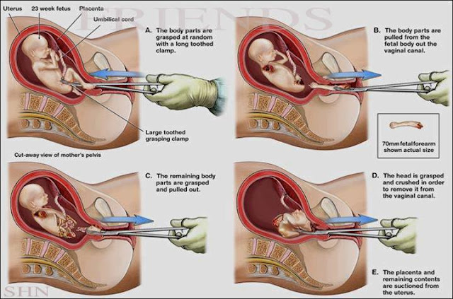 AstaghfirullahSebarkan Biar Banyak yang Tahu!!! Buat Yang Suka Gugurin Bayi, Baca Ini Kalau Berani !!! 