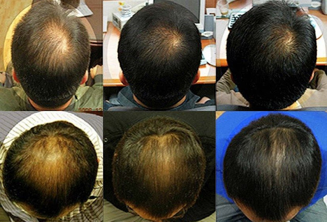 mesotherapy, болталка, процедуры красоты, anti-age, уход за волосами, мезотерапия волос, волосы