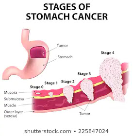 Stomach Cancer: Causes, Symptoms, and Treatment