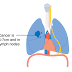 Lung Cancer : Causes, Symptoms, Diagnosis, and Treatment - BlogNews-24