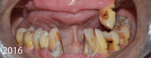 Before dental treatment, only few teeth remaining