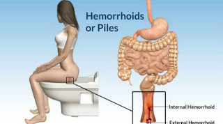 PENYEBAB BAB BERDARAH DAN CARA CEPAT MENGATASINYA,TIPS JITU MENYEMBUHKAN BAB BERDARAH MENGGUNAKAN BAHAN ALAMI