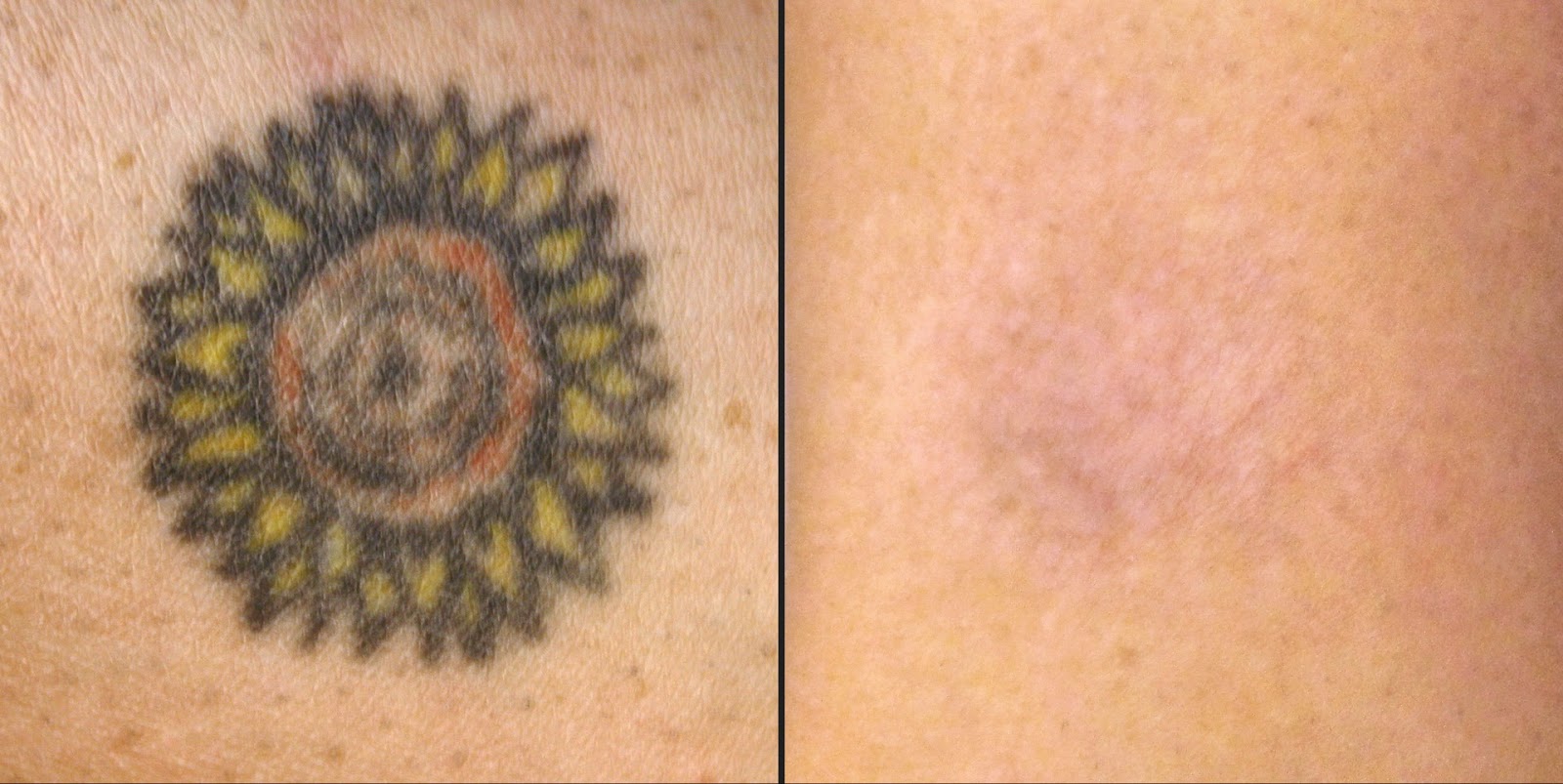 Natural Tattoo Removal: How To Remove Tattoos Naturally?