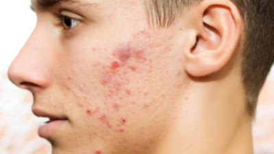 acne en hombres, acne remedios caseros