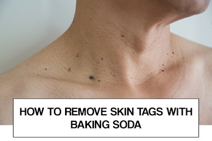 How to Remove Skin Tags With Baking Soda and Castor Oil