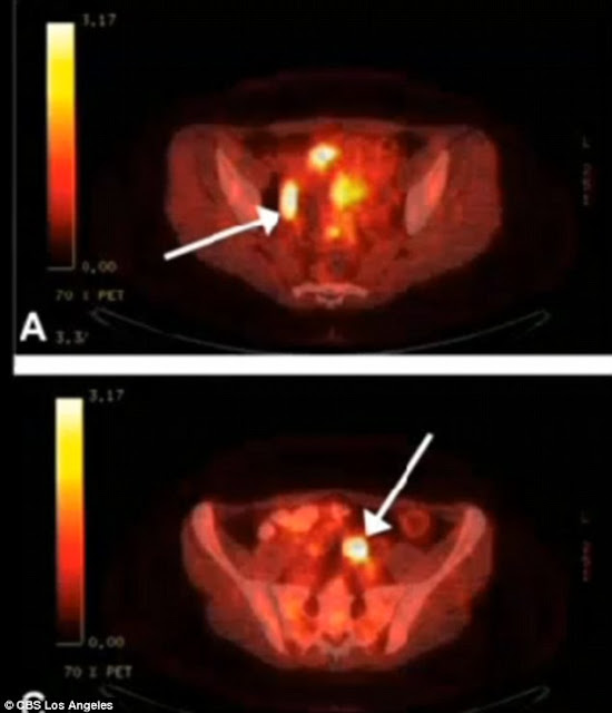 Doctor Mistakes Tattoo Ink For Cancer And Removes Woman's Uterus, Cervix, Fallopian Tubes And Pelvic Lymph Nodes