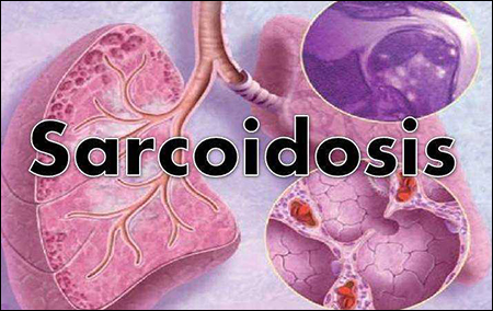 Sarcoidosis, Ayurvedic treatment for sarcoidosis, Sarcoidosis treatment in ayurveda, Allopathic Drugs For Sarcoidosis, Symptoms, Treatment