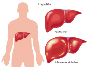 Obat Hepatitis Akut