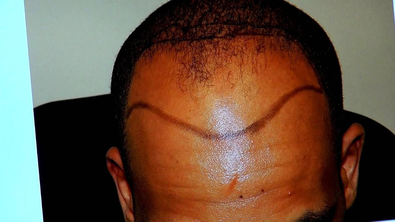 Black Men Balding Black Choices