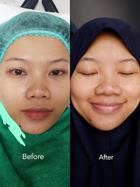 before after treatment zap photo facial acne di zap clinic