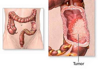 Nguyên nhân triệu chứng của ung thư đại trực tràng