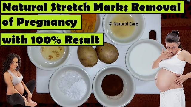 Natural Stretch Marks Removal of Pregnancy with 100% Result