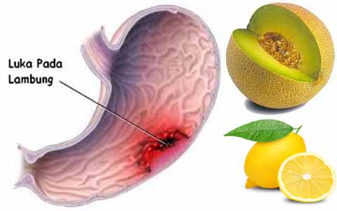 Luar Biasa!!! Kombinasi Melon Dan Lemon Sangat Ampuh Mengatasi Vertigo, Maag Akut, Migrain, Asam Urat, Tolong Sebarkan Ya...