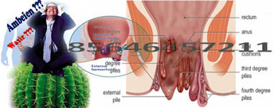 Apa Saja Pantangan Penyakit Wasir Hemorrhoid