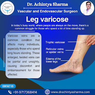Leg varicose: Varicose veins are common, painful, and unsightly, especially with prolonged standing