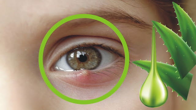How To Get Rid of Chalazion | Chalazion Natural Remedies