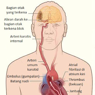  Sinshe Jerry Mengobati Penyakit Stroke