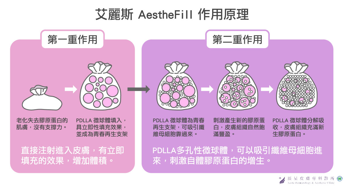 艾麗斯聚雙旋乳酸