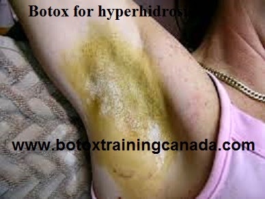 How to use Botox for hyperhidrosis