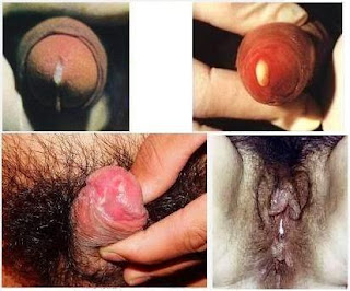 Penyebab penyakit gonorrhea dan sifilis, obat tradisional untuk gonore (kemaluan bernanah), jurnal penyakit gonore, obat gonore (kemaluan bernanah) akut, penyakit sipilis atau raja singa