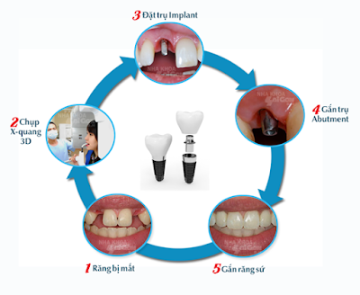 Cấy ghép răng implant có ưu điểm gì?