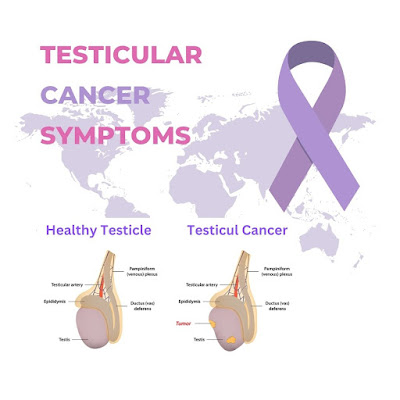 Diagram of testicles with healthy and testicular cancerous conditions