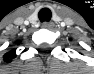 carcinoma medular de tiroides