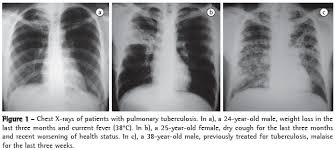 X-ray dada @ chest x-ray - LADY NADIA : MALAYSIAN BLOGGER