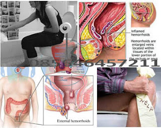 Cara Mengobati Wasir Tanpa Operasi Yg Aman