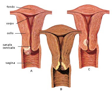 Картинки по запросу tumore al collo dell'utero