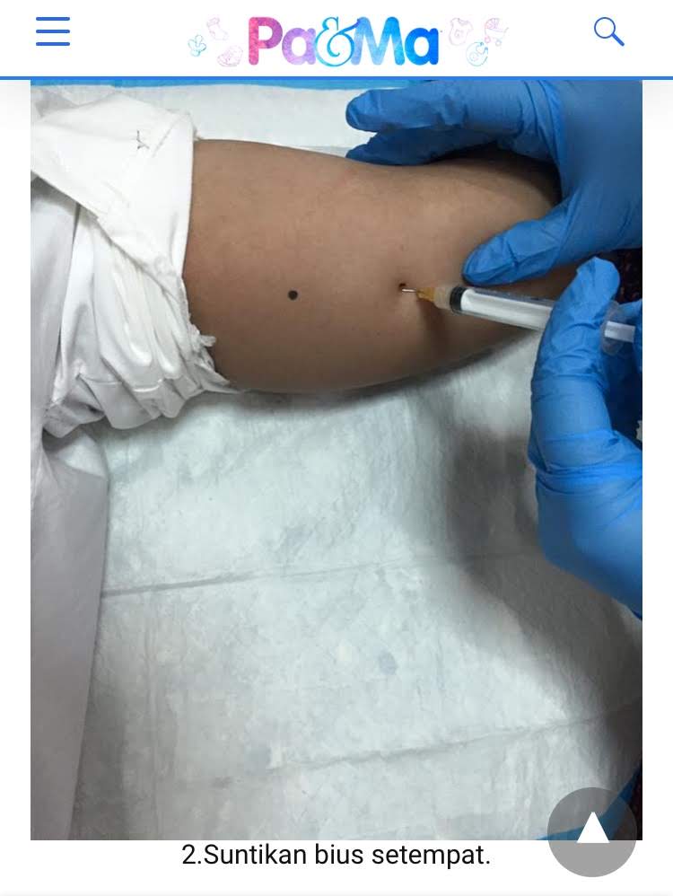 Pengalaman Pakai Rod Implan Sebagai Kaedah Perancang 