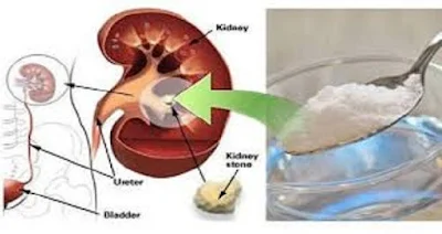 How to Heal Your Kidneys Naturally Using 1 Teaspoon of Baking Soda planet-today.com