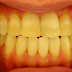 Clareie os Dentes Amarelados