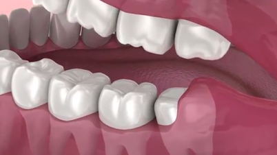 wisdom tooth extraction cost in gurgaon