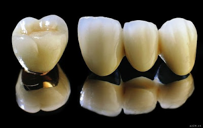 Tổng hợp những loại răng sứ thẩm mỹ