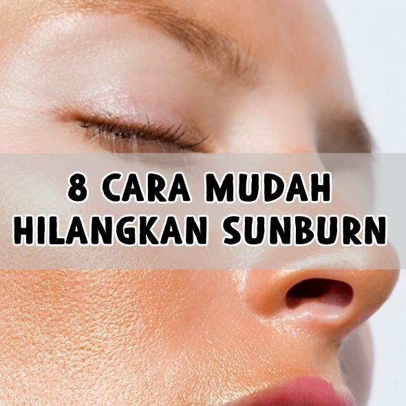 8 Cara Mudah Hilangkan Sunburn 