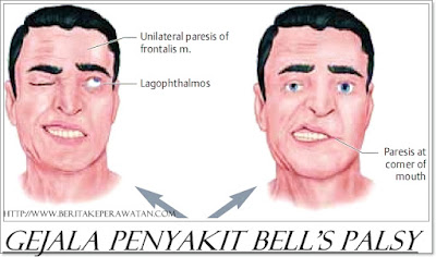 Penyakit Apakah Bell's Palsy