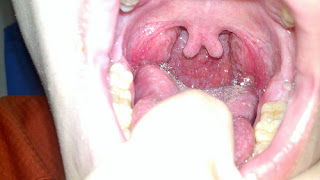 Tonsil And Adenoid Surgery Recovery Time : Tonsillectomy, Anyone_
