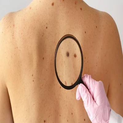 skin cancer treatment,  is skin cancer deadly, early stage skin cancer, skin cancer causes,  how is skin cancer diagnosed, can skin cancer be cured,