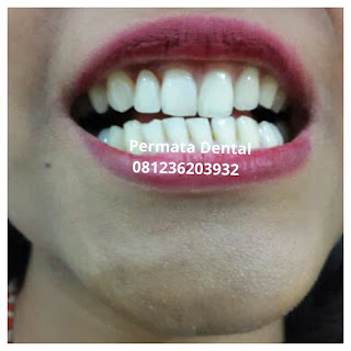 gambar foto contoh sebelum dan sesudah veneer gigi kelinci buatan manis cantik bali jember banyuwangi murah berkualitas di PERMATA DENTAL gambar gigi rusak yang di veneer gigi yang tidak rapi gigi renggang gigi patah cuil rompal pendek karies hitam kuning