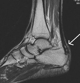 Haglund S Syndrome Sumer S Radiology Blog