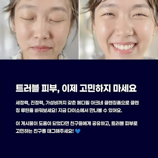 트러블 피부에 강한 이유