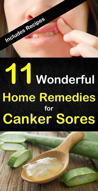 11 Home Remedies to Get Rid of Canker Sores