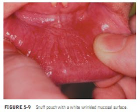 Smokeless Tobacco–Induced Keratosis