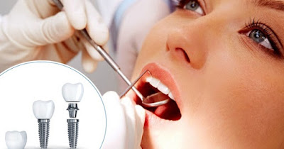 Cấy ghép răng implant ở đâu tốt nhất Hà Nội? 2